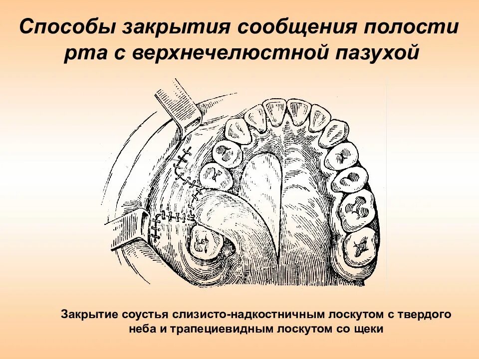 Сообщения полости рта. Способы закрытия ороантрального соустья. Закрытие соустья с гайморовой пазухой. Методы закрытия перфорации верхнечелюстной пазухи. Пластическое закрытие перфорации верхнечелюстной пазухи.