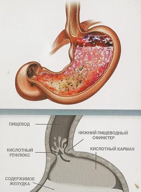 Нижний рефлюкс. Гастроэзофагеальная рефлюкс-болезнь. Рефлюксная болезнь желудка рефлюкс.