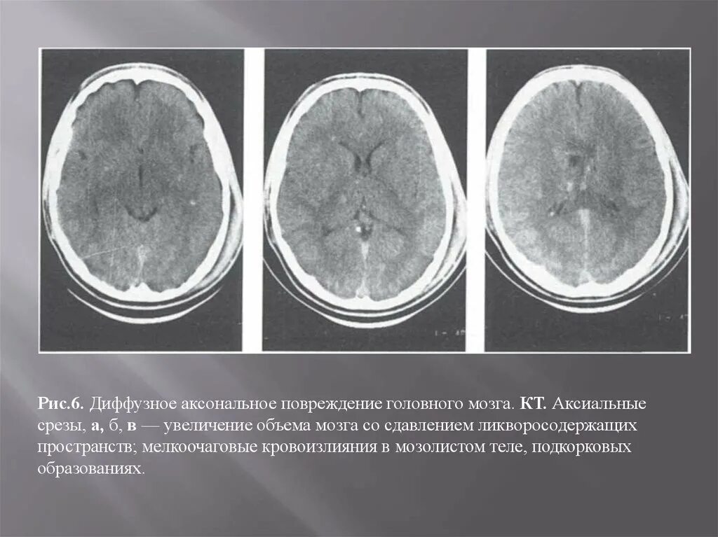 Диффузная травма головного. Диффузное аксональное повреждение кт. Диффузное аксональное повреждение мозга кт. Микроангиопатия головного мозга на кт.