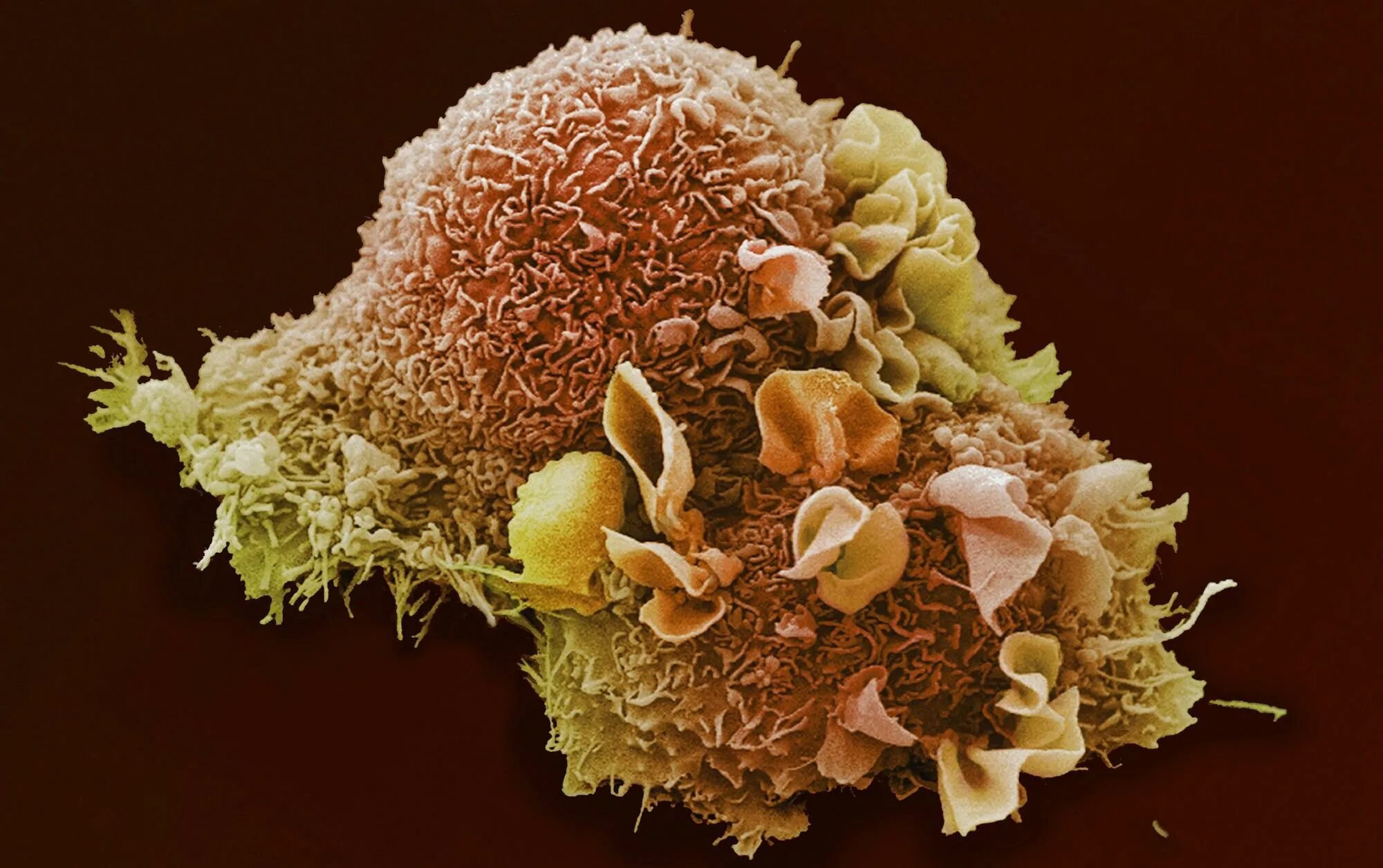 Злокачественная опухоль. Клетки злокачественной опухоли. Питание раковой клетки