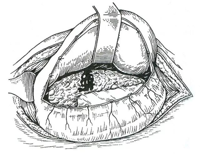 Ушивание разрывов. Травматический разрыв поджелудочной железы. Лапаротомия поджелудочной. Надрыв поджелудочной железы.