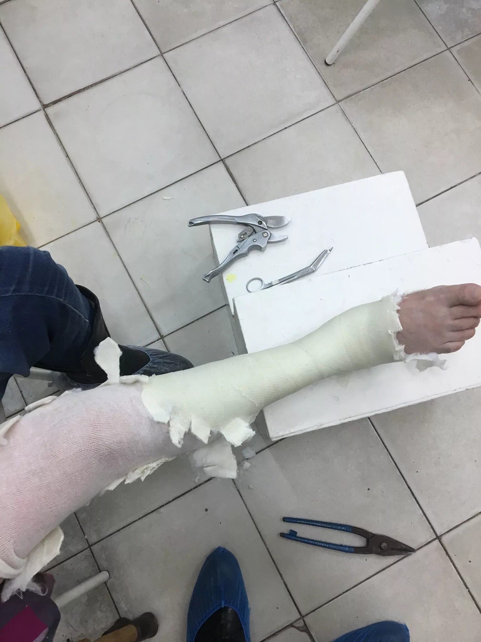 Anlegen eines kurzen Gipsverbands am Bein - Verletzungen; Vergiftungen - MSD Man