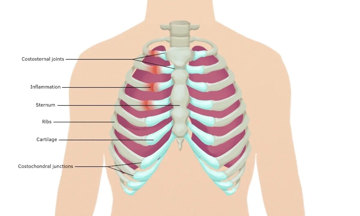 Сильно болит правое ребро. Синдром Титце хондрит реберный. Синдром Титце грудная клетка. Воспаление грудино-реберного сочленения. Синдром Титце воспаление грудинно реберного сочленения.