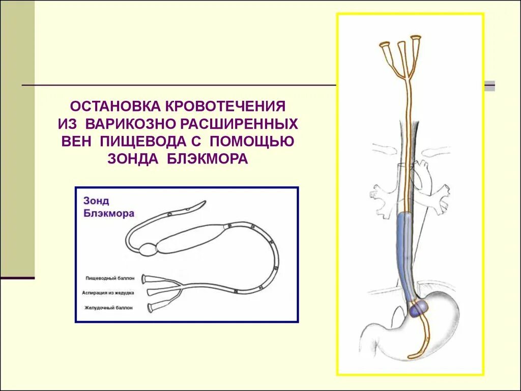 Остановка кровотечения из расширенных вен пищевода. Зонд для остановки кровотечения из варикозно расширенных. Зонд при кровотечении из варикозно расширенных вен пищевода. Остановка кровотечения из варикозно расширенных вен пищевода.