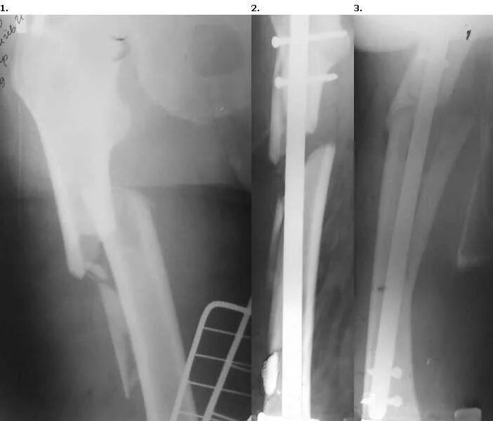 остеосклероз кости рентген. остеофиты головки бедренной кости.