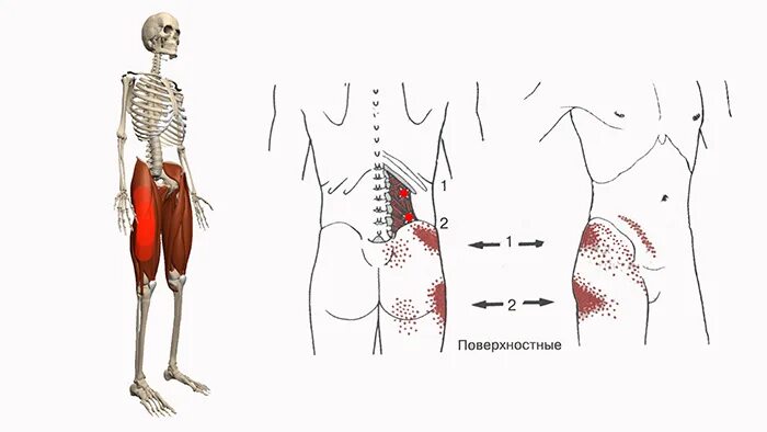 Триггерные точки бедра. Напрягатель широкой фасции триггерные точки. Болит точка на бедре сбоку.