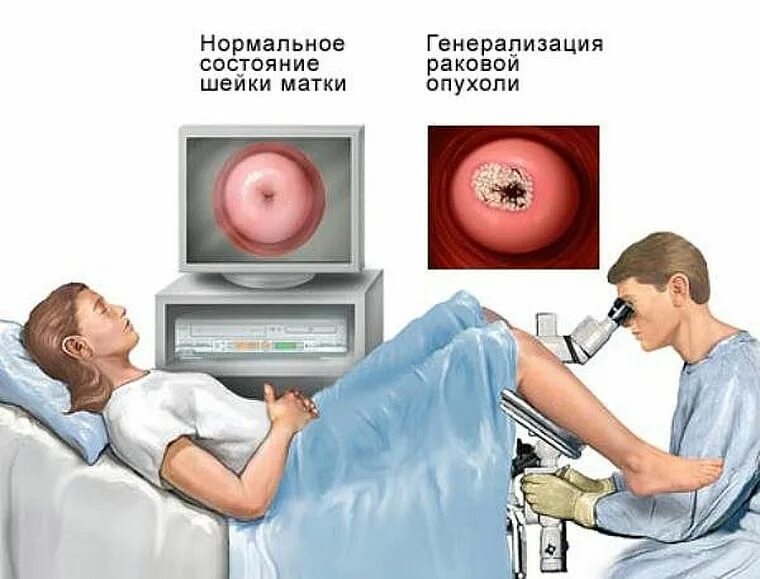 Как выглядит кольпоскопия шейки матки. Расширенная кольпоскопия шейки матки. кольпоскопия биопсия шейки. кольпоскопия здоровой шейки матки.
