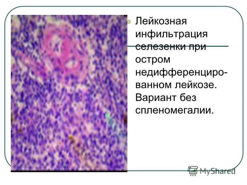 Негомогенная структура что это. Инфильтрация данных. Инфильтрация данных. Аутоиммунный гепатит патогенез. Ревматический миокардит гистология.