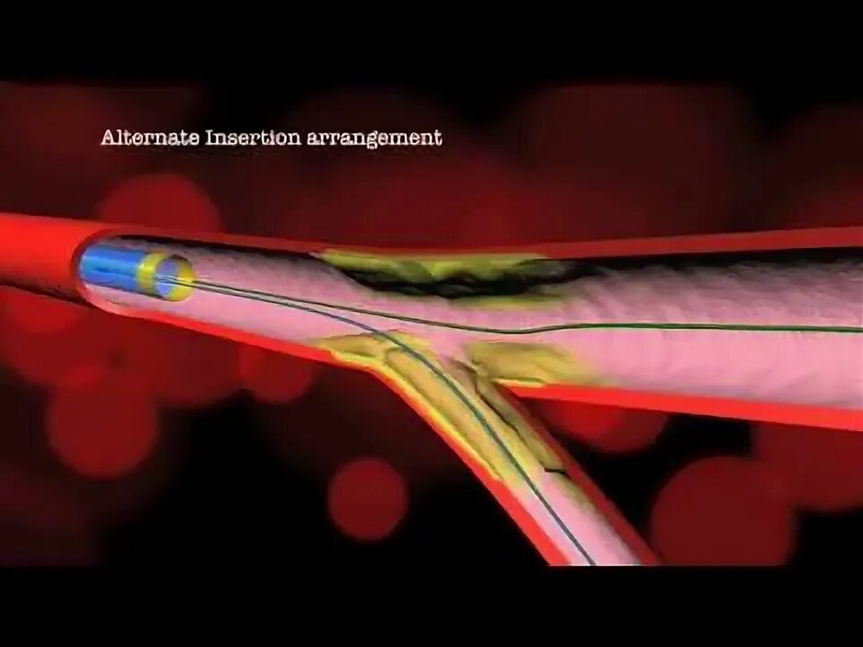 Стентирование собаки. Стент Pipeline. Бифуркационное стентирование provisional. Поток перенаправляющий стент. Пайплайн стент.