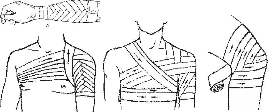 Плечевая повязка алгоритм. Перевязка колосовидная на плечо. Колосовидная повязка на плечевой сустав алгоритм. Колосовидная бинтовая повязка. Перевязка плечевого сустава эластичным бинтом.