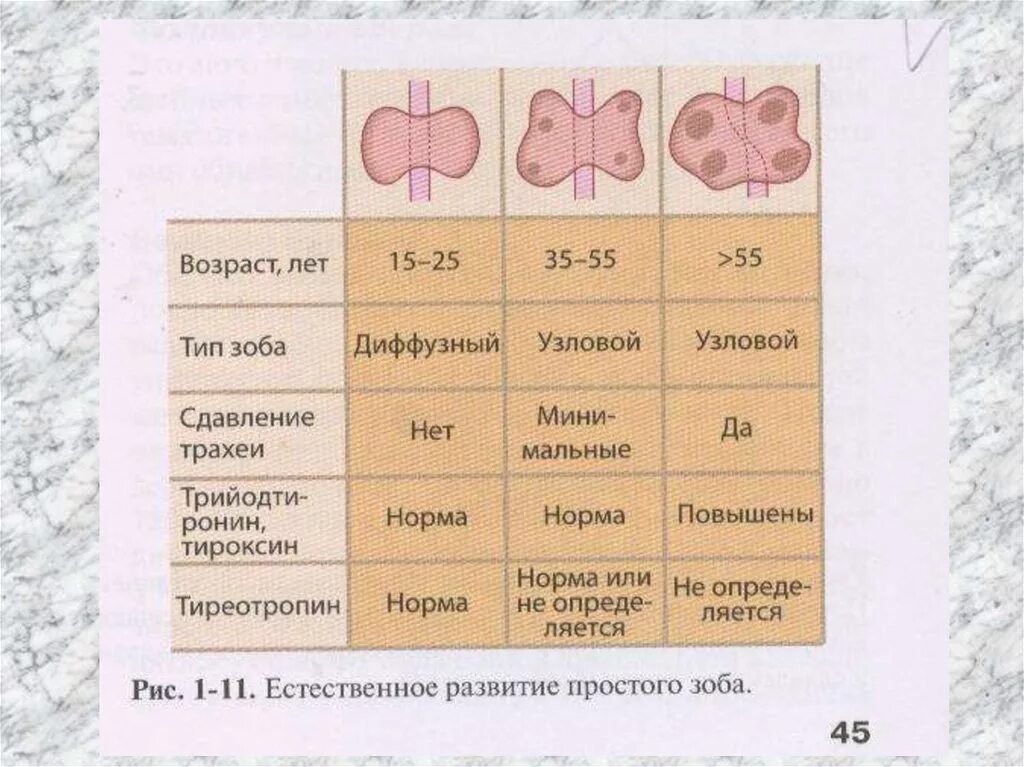 Степени щитовидной железы. Узловой зоб щитовидной железы. Диффузно Узловой зоб 3 степени. Многоузловой диффузный зоб щитовидной железы. Многоузловой диффузный