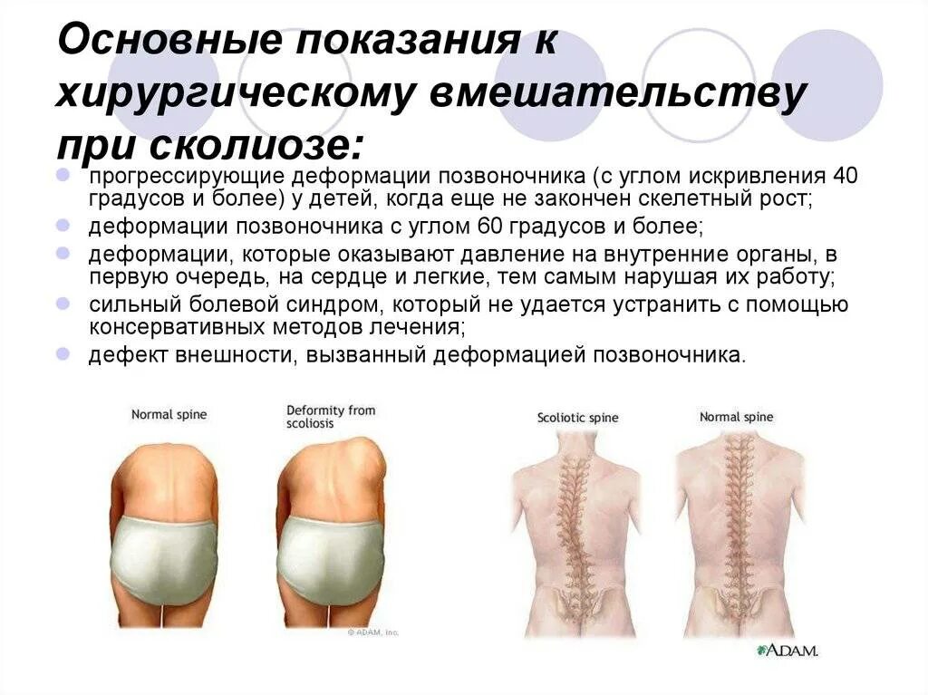 Можно вылечить сколиоз 2 степени. Сколиоз позвоночника. показания к операции при сколиозе. степени сколиоза позвоночника. искривление позвоночника у детей.