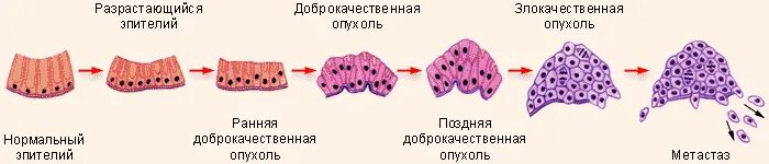 Клетка доброкачественной опухоли. Стадии развития опухоли схема. Развитие злокачественной опухоли 3 стадии. Рост и строение доброкачественных и злокачественных опухолей. Строение доброкачественной и злокачественной опухоли.