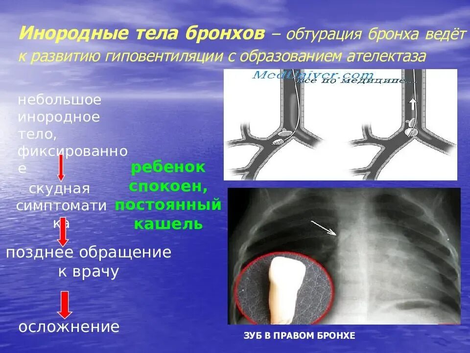 Застряла в трахее