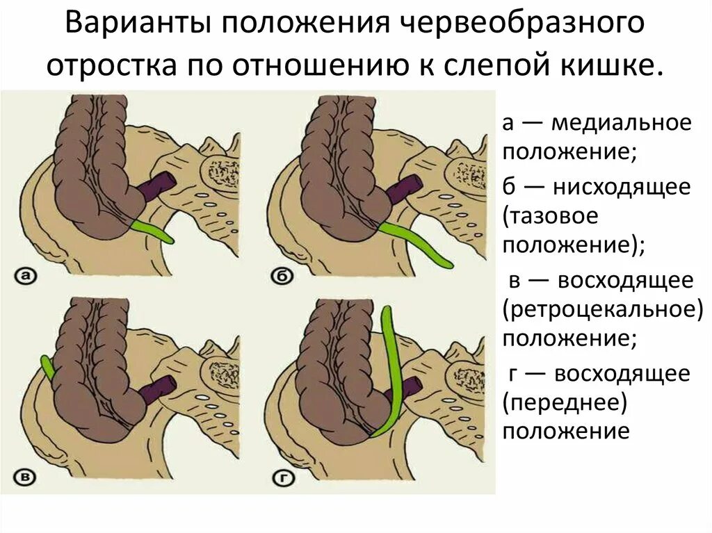 Аппендикс червеобразный. Положения отростка аппендикса. Локализация червеобразного отростка. Ретроцекальное положение аппендикса. Виды расположения червеобразного отростка.