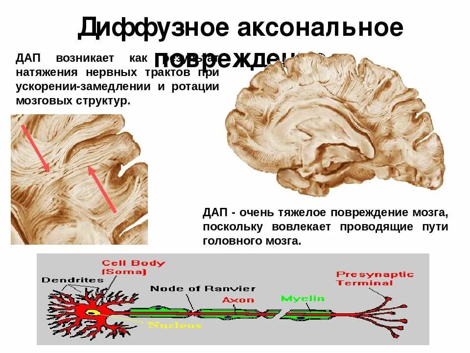 Диффузная травма мозга