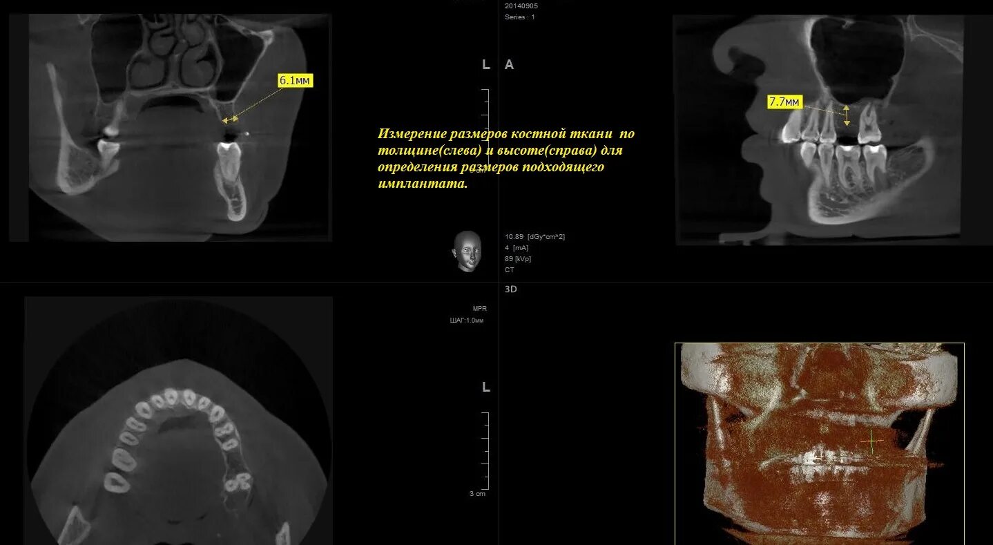 кт зубов уфа. можно ли с имплантами делать кт. дентальная 3d компьютерная томография. можно делать мрт с имплантами зубов. можно делать мрт с имплантами зубов.