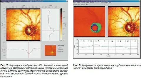 Hrt обследование глаз