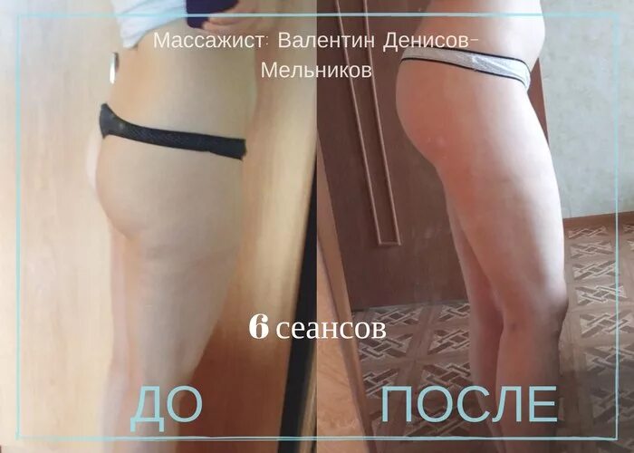 Банки для массажа живота похудения. Баночный массаж до и после. Вакуумный массажер от целлюлита до и после. Баночный массаж для похудения до и после. Массаж вакуумными банками до и после.