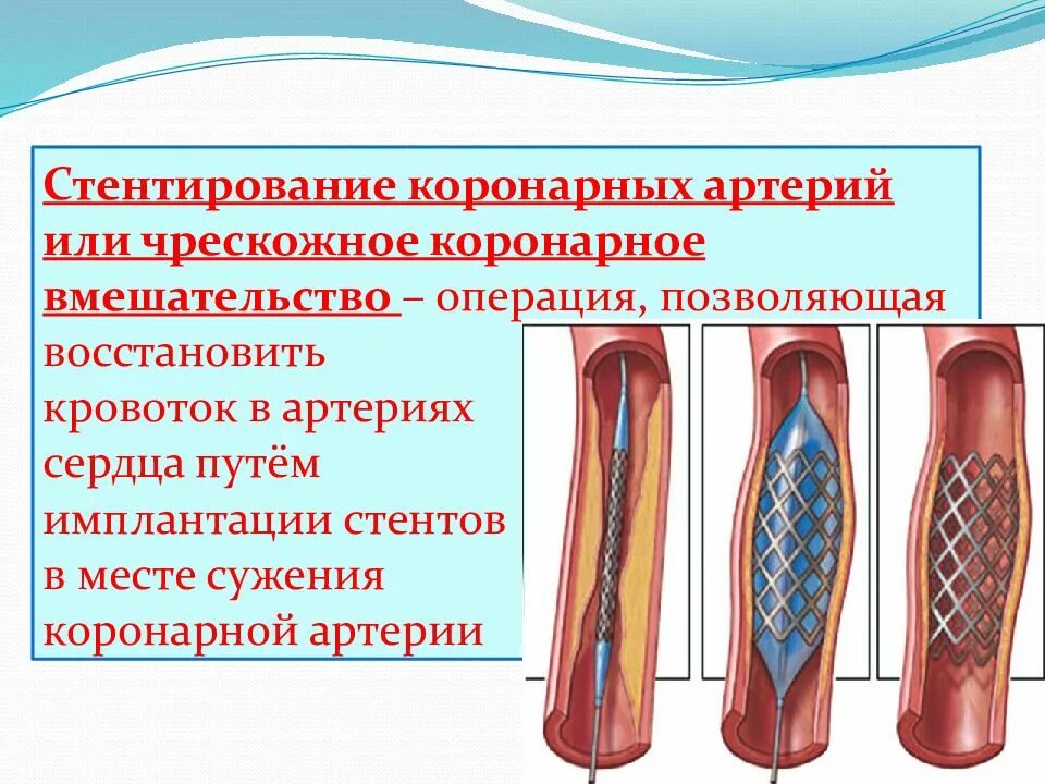 Как ставят стент