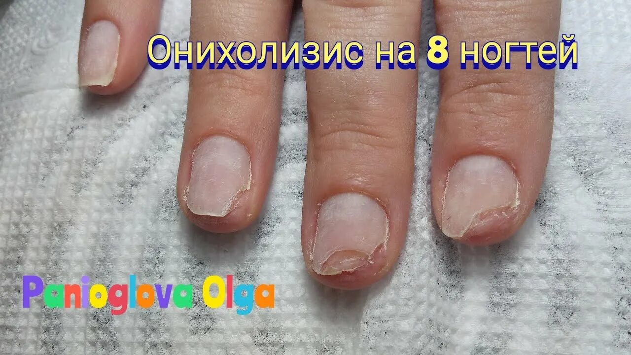 Онихолизис ногтей зачистка. Травматический онихолизис ногтей. Онихолизис можно покрыть гелем