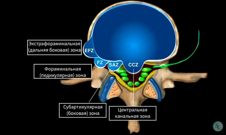 Диффузное выбухание межпозвоночного. Грыжа диска медианно-парамедианная l5-s1 13мм. Протрузия экструзия межпозвонковых дисков позвоночника. Дорзальная левосторонняя фораминальная грыжа диска l5/s1. Экструзии межпозвонковых дисков l5-s1.