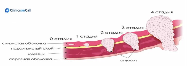 Опухоли по стадиям картинки. Нулевая стадия желудка. Онкология желудка 4 стадия с метастазами. Онкология желудка 4 стадия