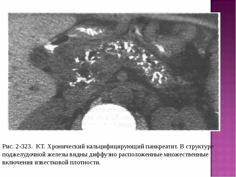 Диффузные изменения панкреатит. Диффузные изменения панкреатит. Изменение поджелудочной железы на узи. Диффузные изменения панкреатит. Умеренные диффузные изменения поджелудочной.