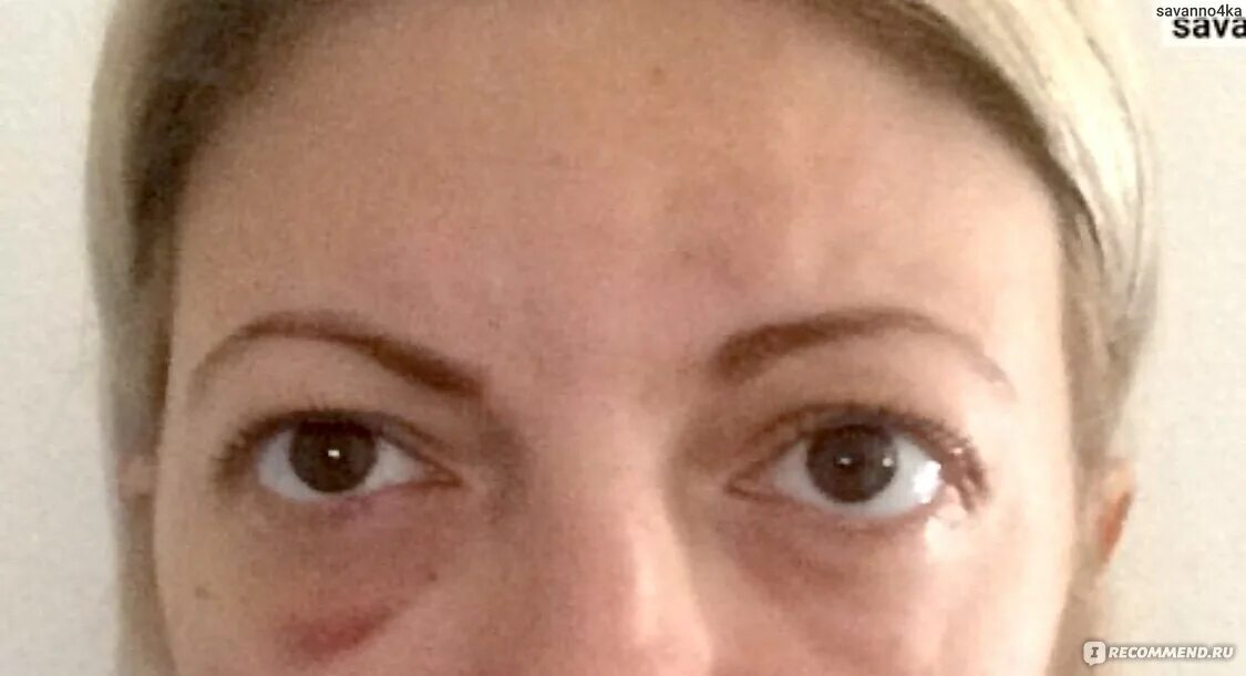 Периорбитальной грыжи. Блефаропластика век грыжи. Жировые грыжи верхних век. Блефаропластика грыжи верхнего века. Блефаропластика нижних век грыжи.