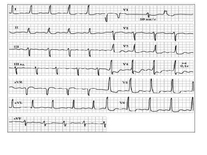 Диффузно дистрофические изменения миокарда левого желудочка ЭКГ. Диффузные изменения миокарда левого желудочка на ЭКГ. Диффузное поражение миокарда ЭКГ. ЭКГ выраженные диффузные изменения миокарда. Диффузная реполяризации левого желудочка