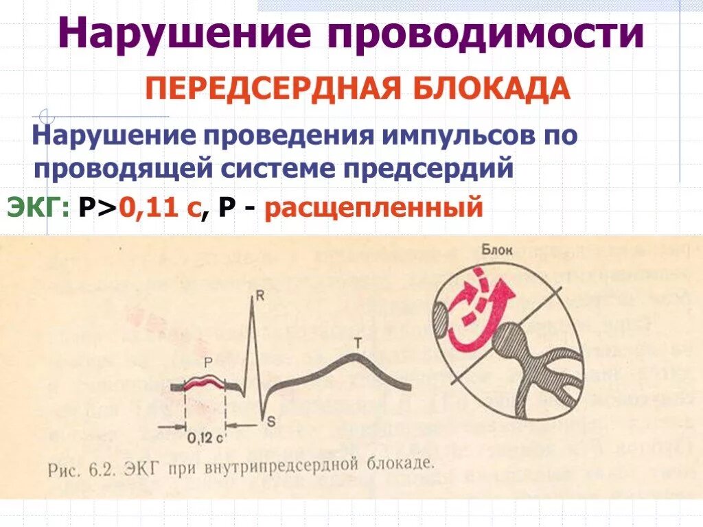 Что значит внутрипредсердная внутрипредсердная блокада. Нарушения проводимости сердца блокады ЭКГ. Электрокардиограмма при нарушениях проводимости. Нарушение функции проводимости ЭКГ. Нарушения желудочковой проводимости на ЭКГ.