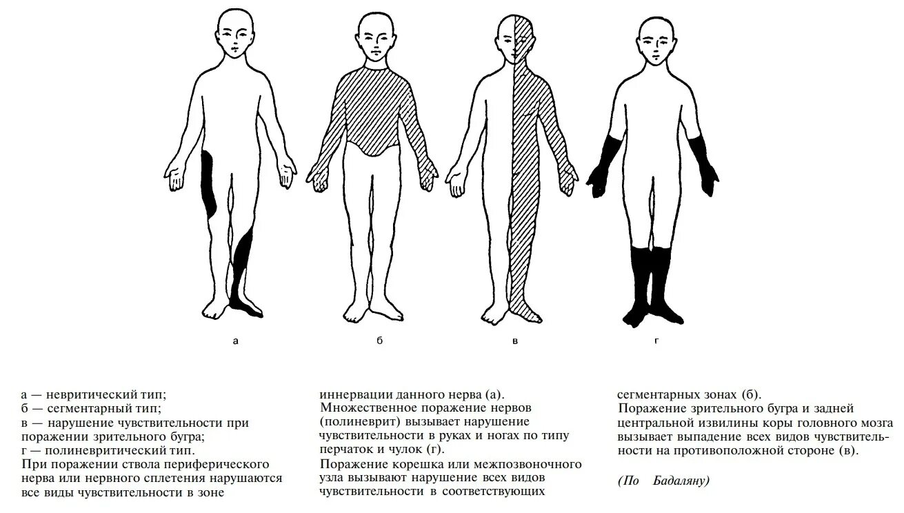 Типы поражения чувствительности. Чувствительность типы расстройства чувствительности. Периферический Тип расстройства чувствительности. Периферический корешковый Тип нарушения чувствительности. Корковый Тип нарушения чувствительности неврология.