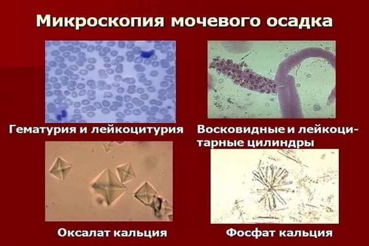 Неорганизованный осадок мочи микроскопия. Микроскопия органического осадка мочи. Моча микроскопическое исследование. Микроскопическое исследование мочевого осадка.