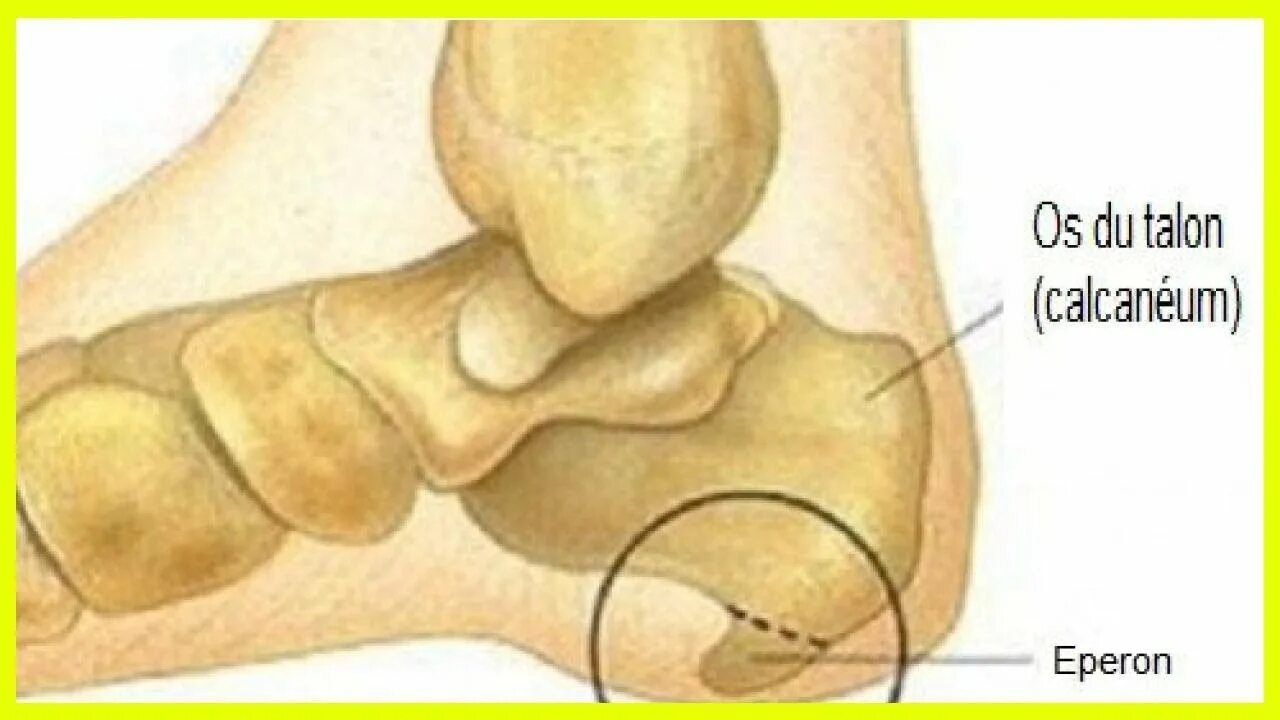 Пяточный шип. Пяточный шип. Подошвенный экзостоз пяточной кости. Плантарный фасциит пяточной кости. Плантарный фасциит пяточной кости.