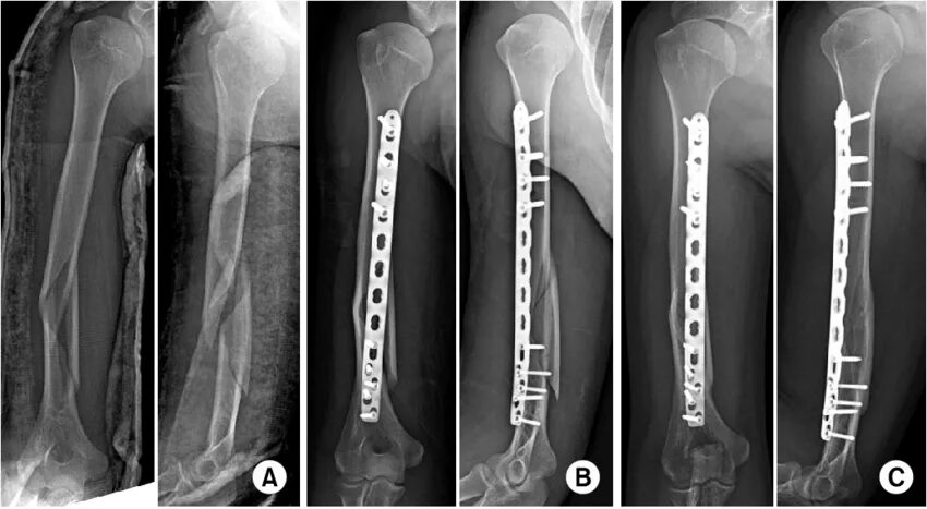 Остеосинтез диафиза бедренной кости рентген. Экстрамедуллярный остеосинтез. Перелом плечевой кости экстрамедуллярный остеосинтез. Накостный остеосинтез н/3 лучевой кости. Перелом плеча пластина
