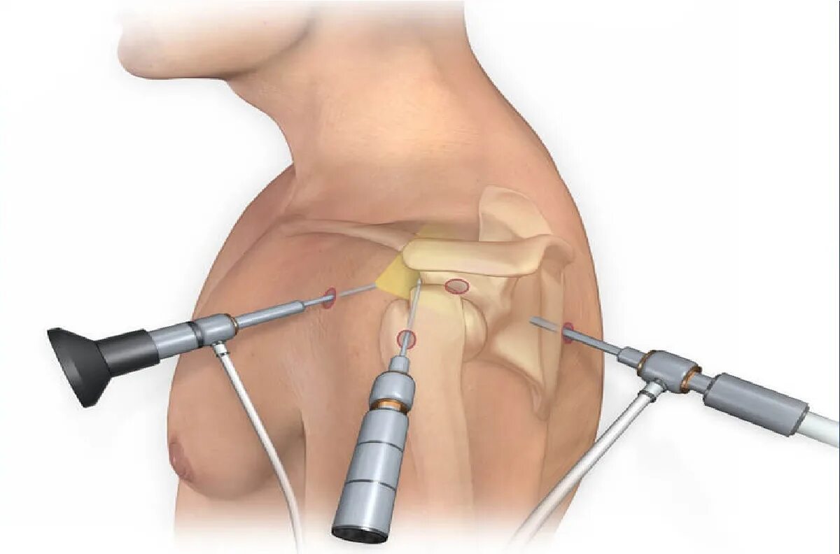 Артроскопическая резекция мениска. Операция артроскопия коленного сустава. Артроскопия коленного мениска. Разрыв мениска артроскопия. Операция по замене плечевого сустава