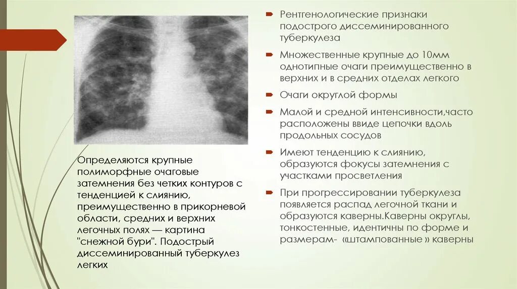 Что означает изменения в легких. Рентген признаки диссеминированного туберкулеза легких. Рентгенологические признаки диссеминированного туберкулеза. Диссеминированный туберкулез легких рентген. Подострый диссеминированный туберкулез легких диагностика.