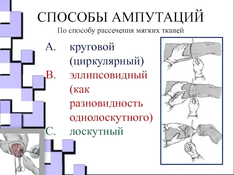 Лоскутная ампутация. Классификация ампутаций. Виды лоскутных ампутаций. Классификация ампутаций по форме рассечения мягких тканей.