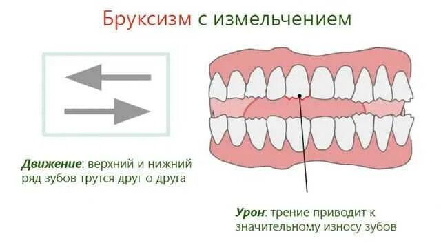 Скрежет зубами у взрослого причины. Взорослый скририпит зубамт. Скрипение зубами во сне.