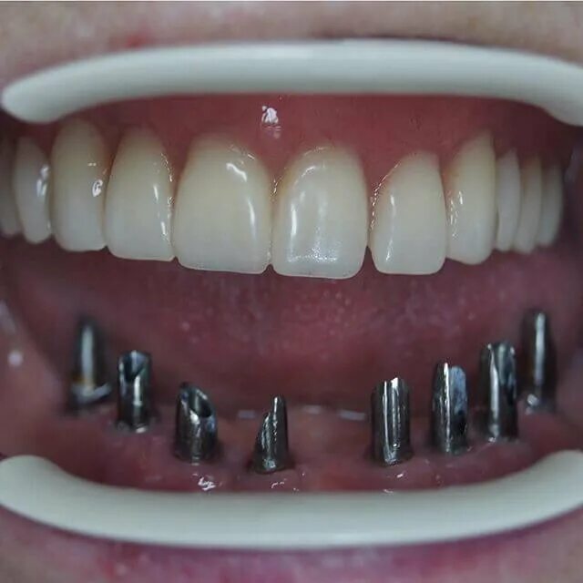 Имплант neodent. 4 штифта зубы. 4 штифта зубы. Имплантация формирователь osstem. Керамический зуб на штифте.
