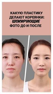 Корейская пластика