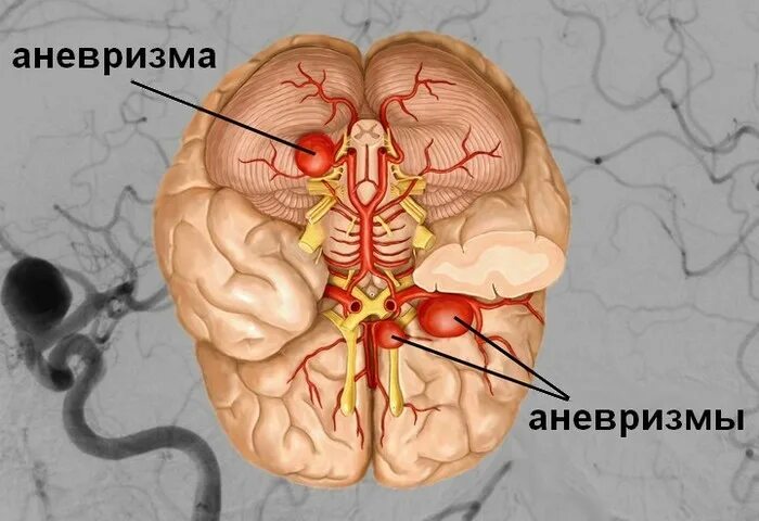 Аневризма головного мозга. Аневризмы артерий головного мозга. Артериальные аневризмы сосудов головного мозга. Аневризма головного сосудов. Аневризма мозга простыми словами