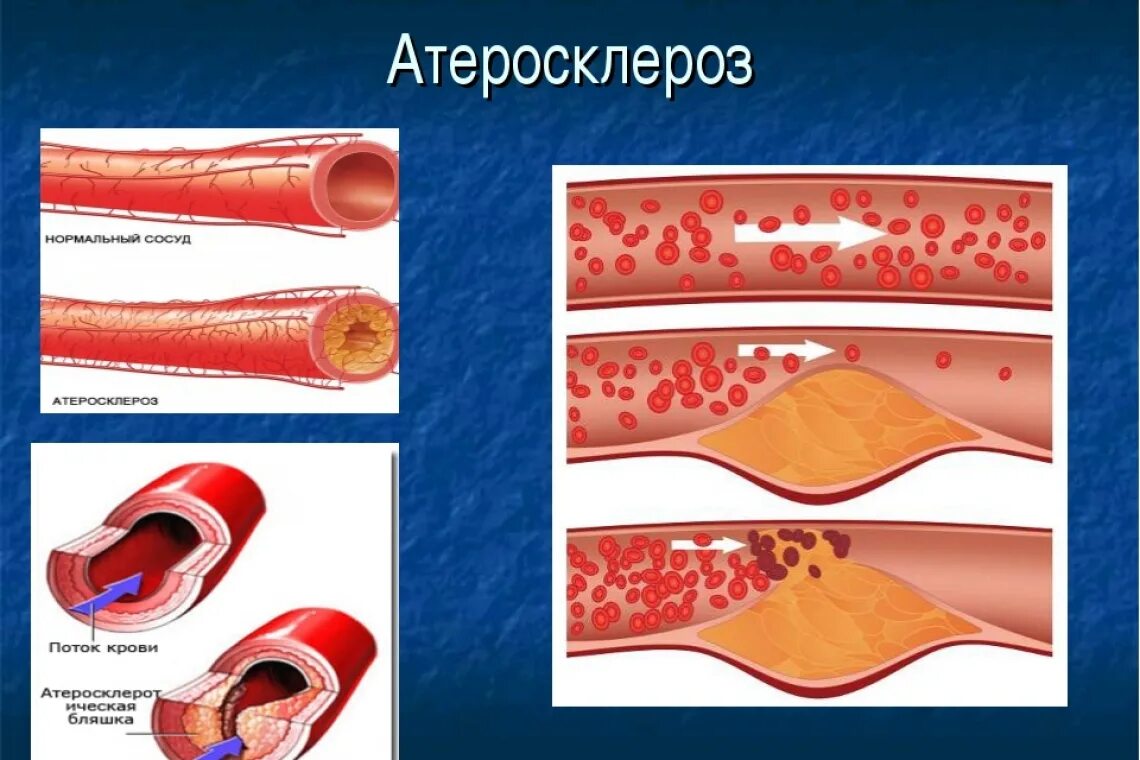 Атеросклероз у взрослого