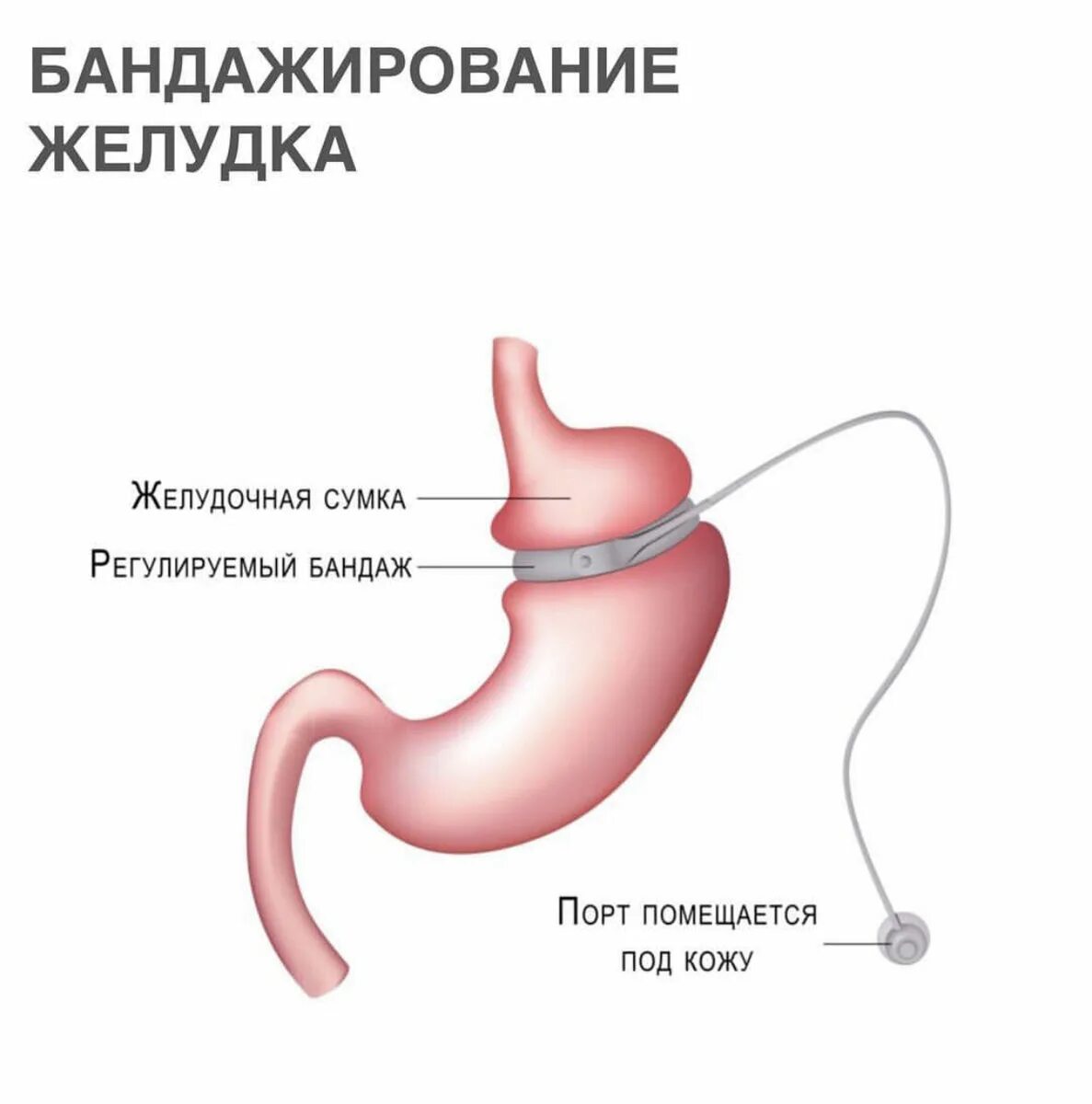Как называется операция по уменьшению желудка. Gastric band. лапароскопическое бандажирование желудка. бариатрическая хирургия. бариатрическая операция на желудке.