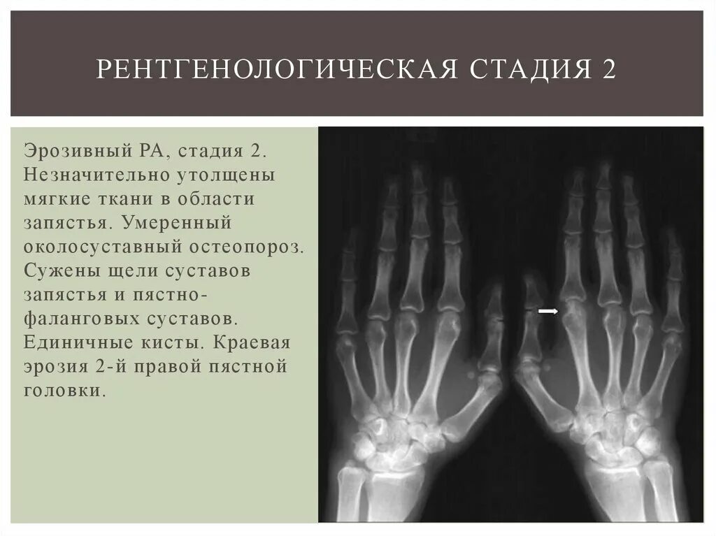 Ревматоидный артрит 2 стадии рентген. 2 Рентгенологическая стадия ревматоидного артрита. Ревматоидный артрит кисти рентген. Рентгенологические степени ревматоидного артрита. Артрит фаланговых суставов