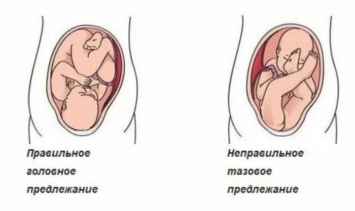 Предлежание головой. Предлежание головное продольное на 32 неделе. Головное и тазовое предлежание плода. Позиция плода при головном предлежании. Положение плода продольное тазовое 1 позиция.