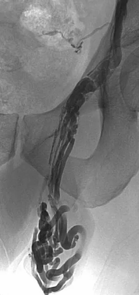 варикоцеле 3 стадия