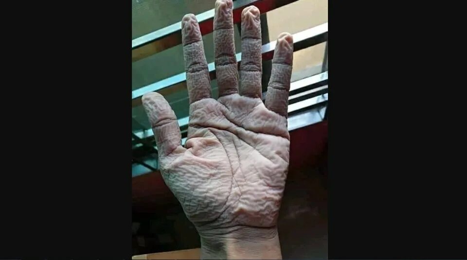 Как выглядит рука после. Как выглядит рука после. Костный мозоль при переломе лучевой кости. Трещина лучевой кости руки. Как выглядит рука после.