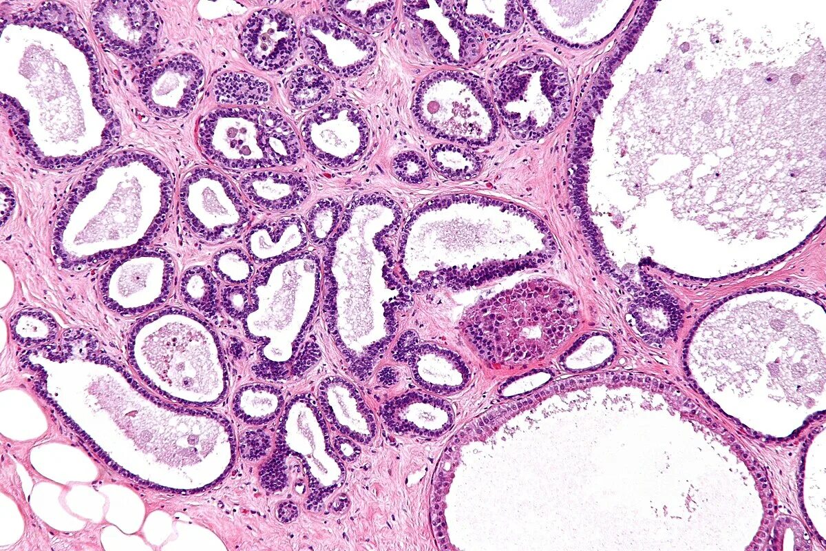 File:Helicobacter-Gastritis 6.jpg - Wikimedia Commons