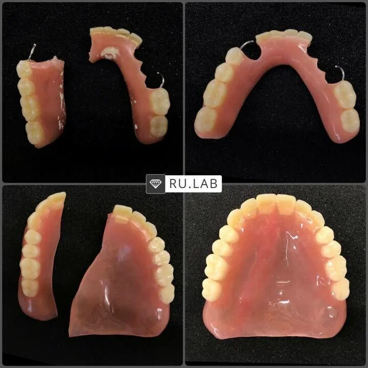 Чем можно приклеить зуб. Починка съемного протеза. Пластмассовые зубные протезы.